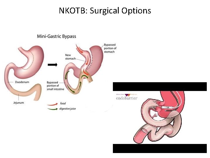 NKOTB: Surgical Options 