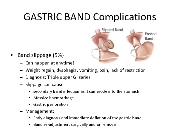 GASTRIC BAND Complications • Band slippage (5%) – – Can happen at anytime! Weight