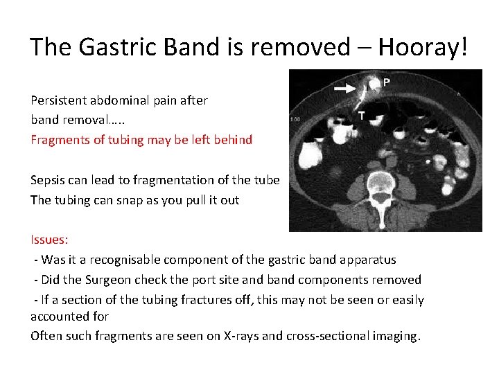 The Gastric Band is removed – Hooray! Persistent abdominal pain after band removal…. .