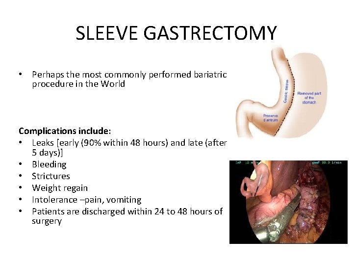 SLEEVE GASTRECTOMY • Perhaps the most commonly performed bariatric procedure in the World Complications