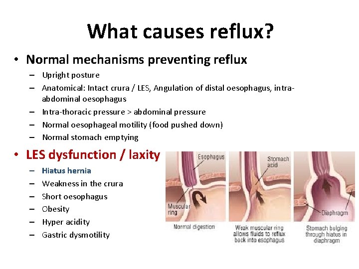 What causes reflux? • Normal mechanisms preventing reflux – Upright posture – Anatomical: Intact