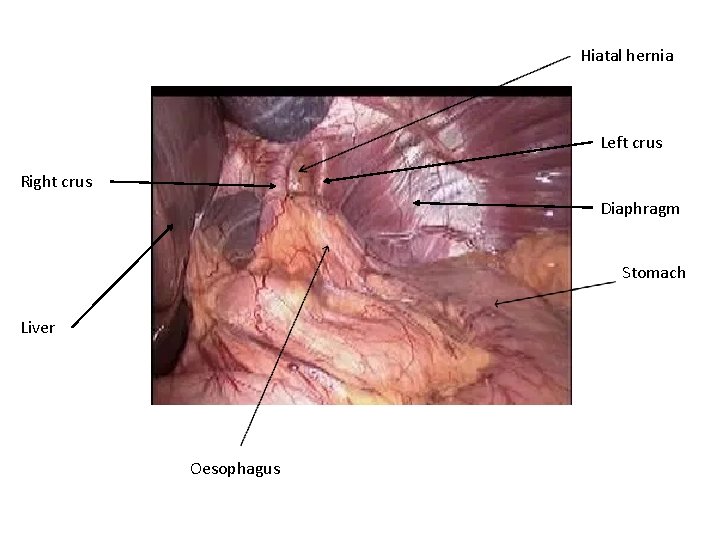 Hiatal hernia Left crus Right crus Diaphragm Stomach Liver Oesophagus 