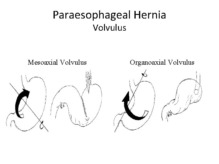 Paraesophageal Hernia Volvulus Mesoaxial Volvulus Organoaxial Volvulus 
