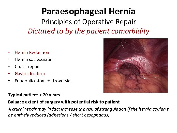 Paraesophageal Hernia Principles of Operative Repair Dictated to by the patient comorbidity • •