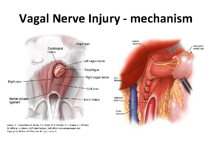 Vagal Nerve Injury - mechanism 