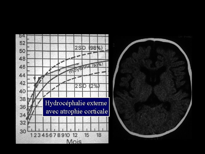 Hydrocéphalie externe avec atrophie corticale 