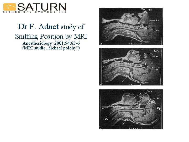 Dr F. Adnet study of Sniffing Position by MRI Anesthesiology 2001; 94: 83 -6