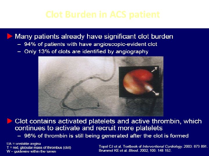 Clot Burden in ACS patient 