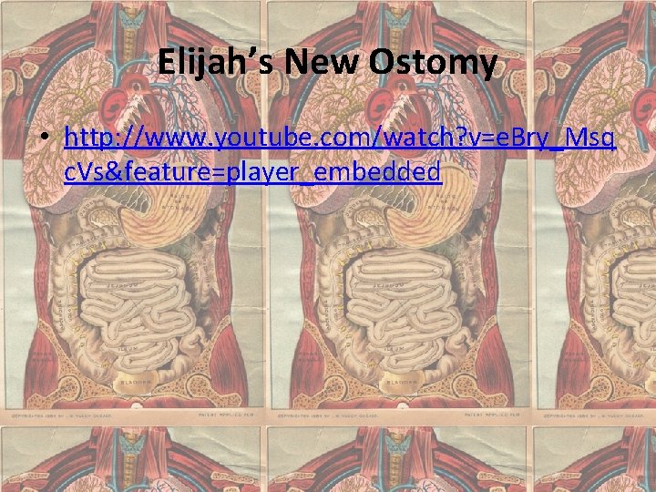 Elijah’s New Ostomy • http: //www. youtube. com/watch? v=e. Bry_Msq c. Vs&feature=player_embedded 