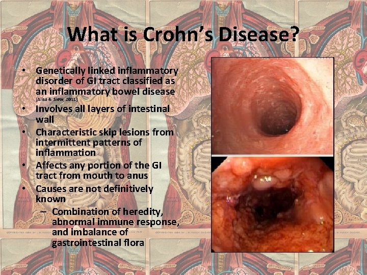 What is Crohn’s Disease? • Genetically linked inflammatory disorder of GI tract classified as