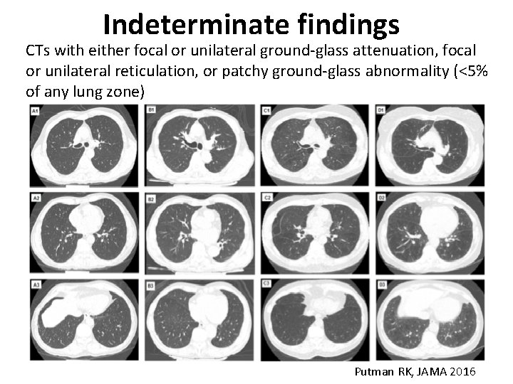 Indeterminate findings CTs with either focal or unilateral ground-glass attenuation, focal or unilateral reticulation,