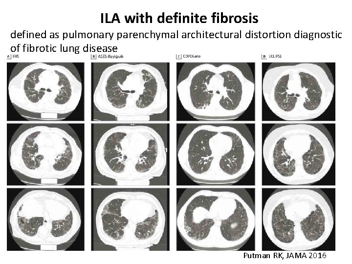 ILA with definite fibrosis defined as pulmonary parenchymal architectural distortion diagnostic of fibrotic lung