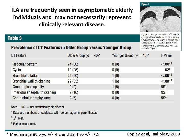 ILA are frequently seen in asymptomatic elderly individuals and may not necessarily represent clinically