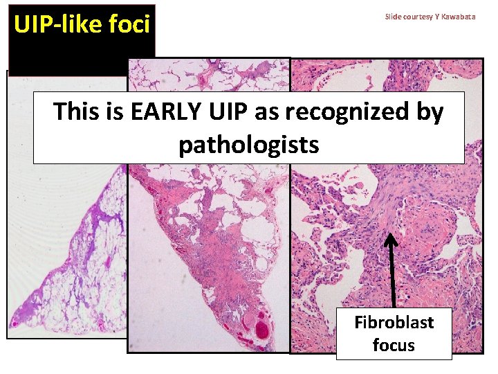 UIP-like foci Slide courtesy Y Kawabata This is EARLY UIP as recognized by pathologists