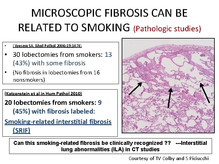 MICROSCOPIC FIBROSIS CAN BE RELATED TO SMOKING (Pathologic studies) • (Yousem SA. Mod Pathol