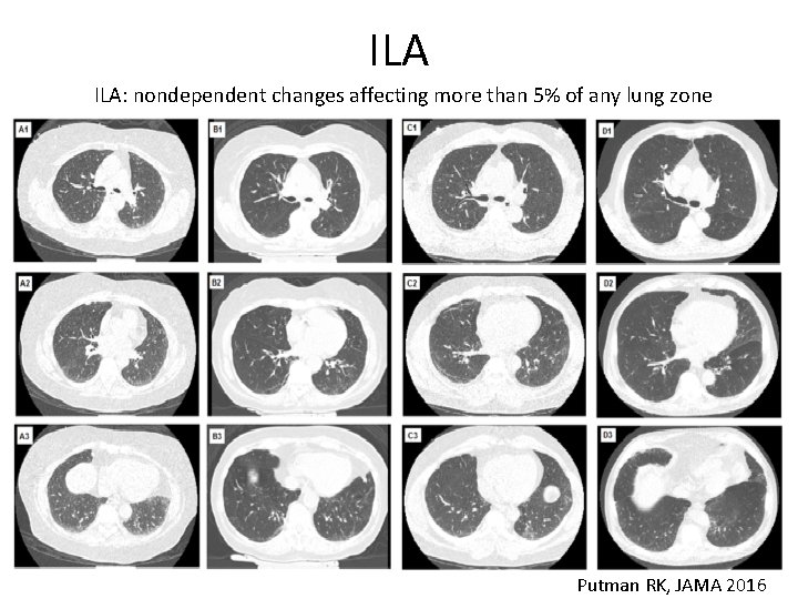 ILA ILA: nondependent changes affecting more than 5% of any lung zone Putman RK,