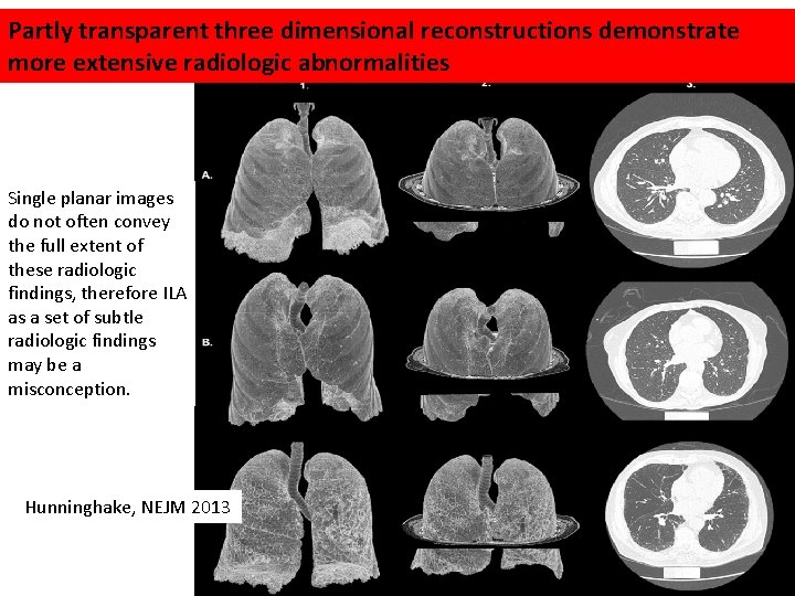 Partly transparent three dimensional reconstructions demonstrate more extensive radiologic abnormalities Single planar images do