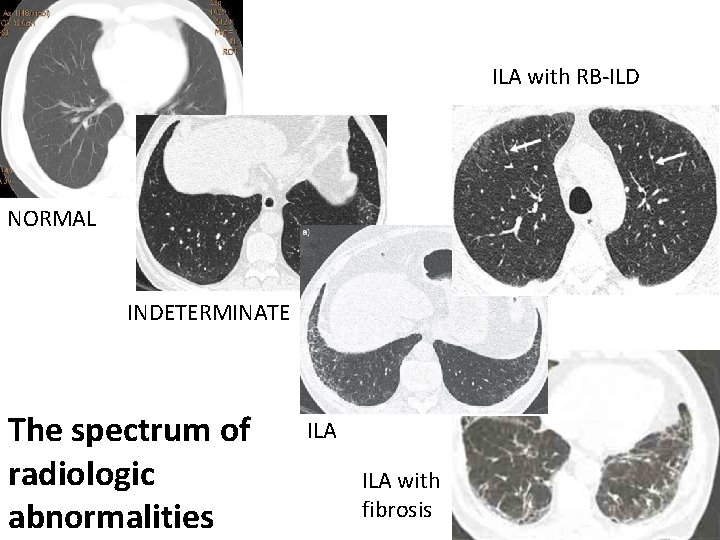 ILA with RB-ILD NORMAL INDETERMINATE The spectrum of radiologic abnormalities ILA with fibrosis 