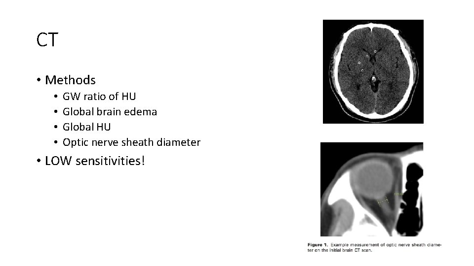 CT • Methods • • GW ratio of HU Global brain edema Global HU CT • Methods • • GW ratio of HU Global brain edema Global HU