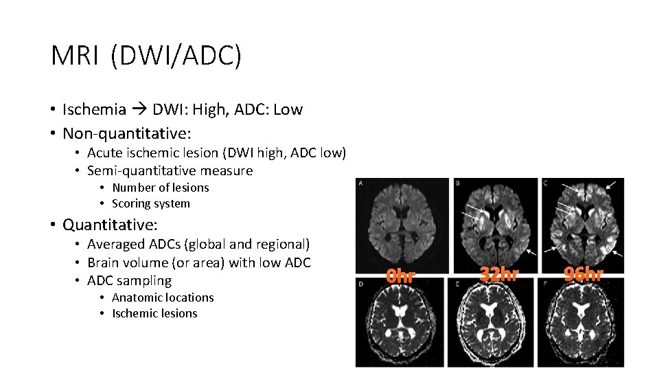 MRI (DWI/ADC) • Ischemia DWI: High, ADC: Low • Non-quantitative: • Acute ischemic lesion MRI (DWI/ADC) • Ischemia DWI: High, ADC: Low • Non-quantitative: • Acute ischemic lesion