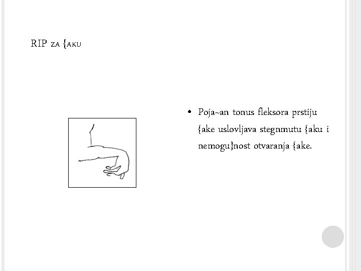 RIP ZA {AKU • Poja~an tonus fleksora prstiju {ake uslovljava stegnmutu {aku i nemogu}nost