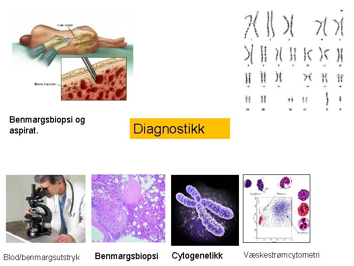 Benmargsbiopsi og aspirat. Blod/benmargsutstryk Diagnostikk Benmargsbiopsi Cytogenetikk Væskestrømcytometri 