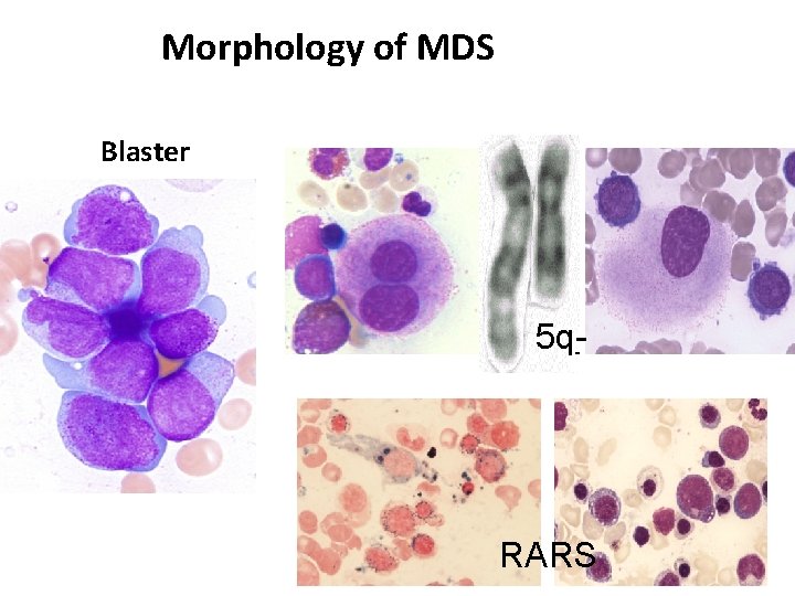 Morphology of MDS Blaster 5 q- RARS 