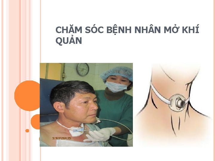 CHĂM SÓC BỆNH NH N MỞ KHÍ QUẢN 