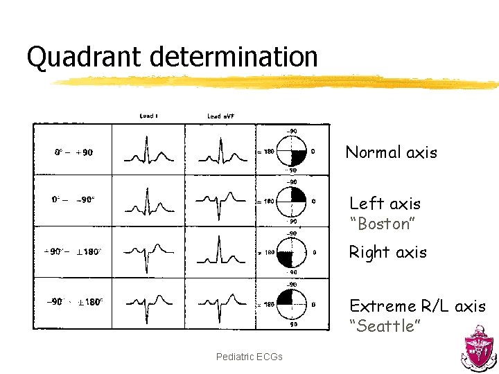 Quadrant determination Normal axis Left axis “Boston” Right axis Extreme R/L axis “Seattle” Pediatric