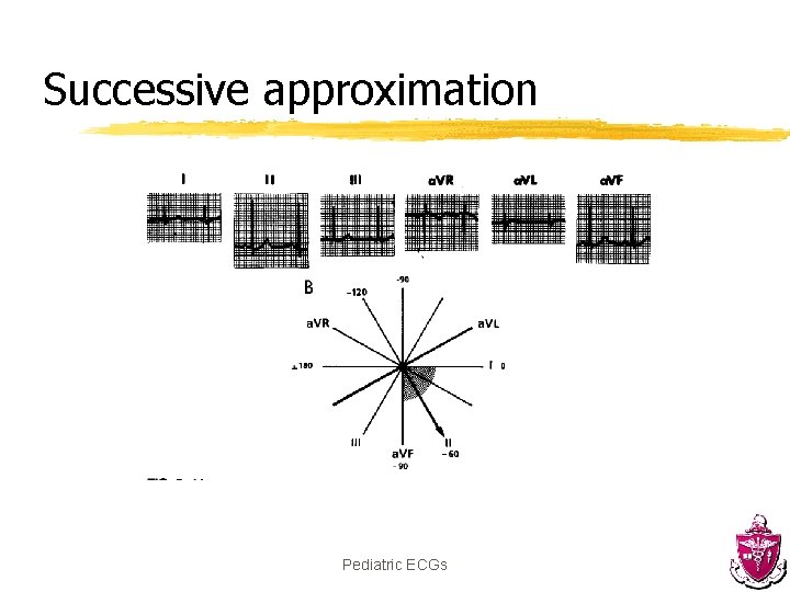 Successive approximation Pediatric ECGs 