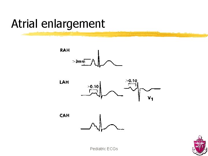 Atrial enlargement Pediatric ECGs 