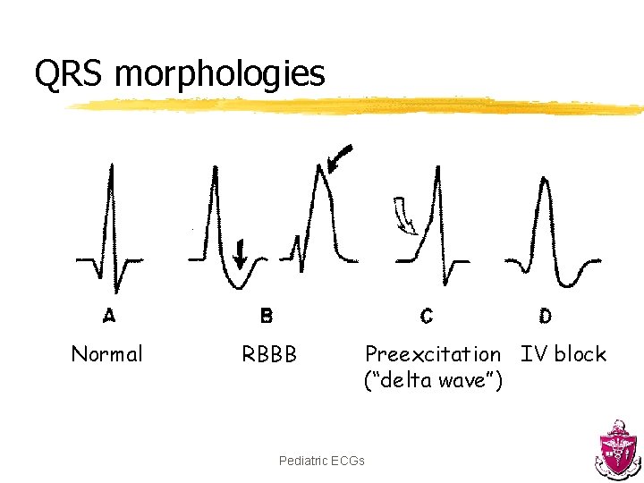 QRS morphologies Normal RBBB Preexcitation IV block (“delta wave”) Pediatric ECGs 