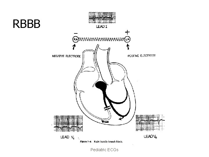 RBBB Pediatric ECGs 