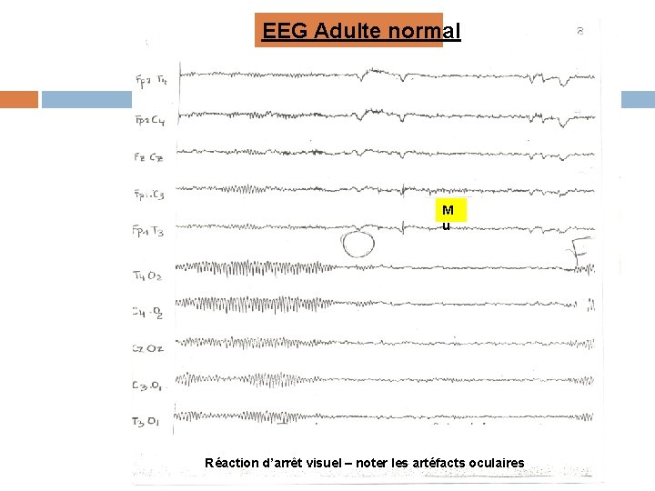 EEG Adulte normal M u Réaction d’arrêt visuel – noter les artéfacts oculaires 