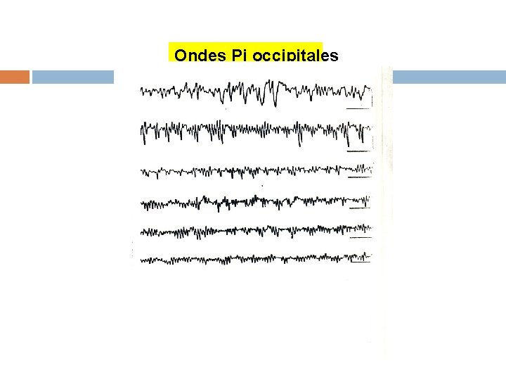 Ondes Pi occipitales 