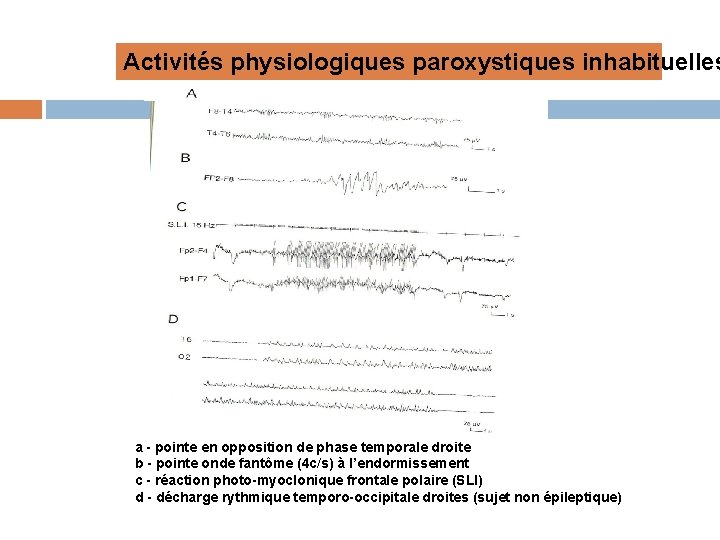 Activités physiologiques paroxystiques inhabituelles a - pointe en opposition de phase temporale droite b