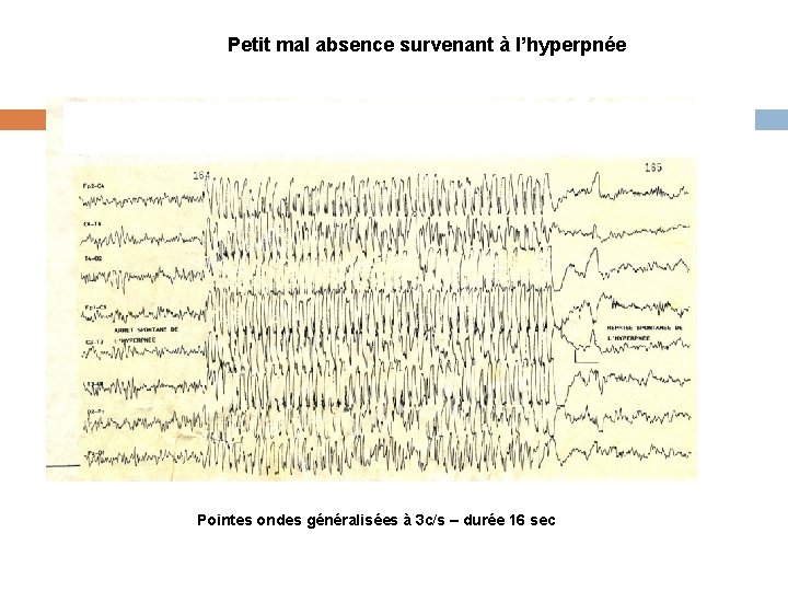 Petit mal absence survenant à l’hyperpnée Pointes ondes généralisées à 3 c/s – durée