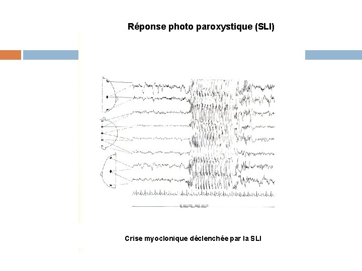 Réponse photo paroxystique (SLI) Crise myoclonique déclenchée par la SLI 