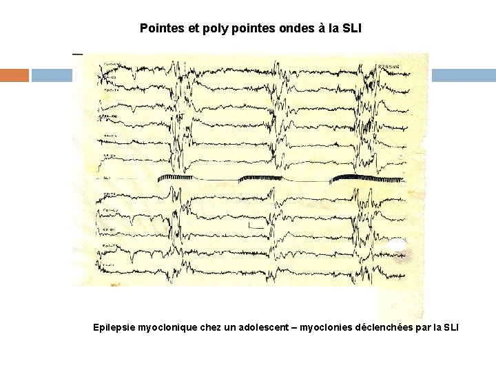 Pointes et poly pointes ondes à la SLI Epilepsie myoclonique chez un adolescent –