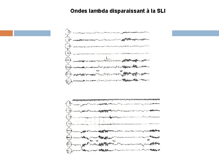 Ondes lambda disparaissant à la SLI 