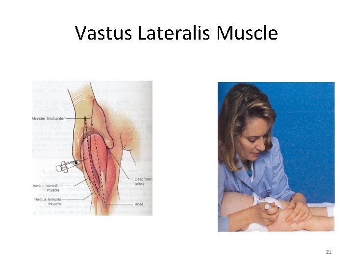 Vastus Lateralis Muscle 21 
