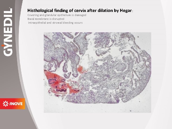 Histhological finding of cervix after dilation by Hegar : Covering and glandular epithelium is