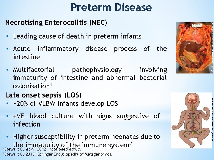 Preterm Disease • Leading cause of death in preterm infants • Acute inflammatory disease