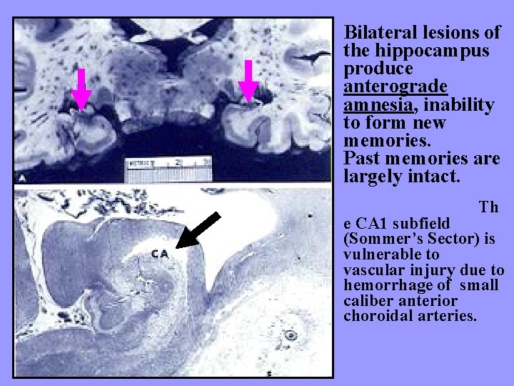 Bilateral lesions of the hippocampus produce anterograde amnesia, inability to form new memories. Past