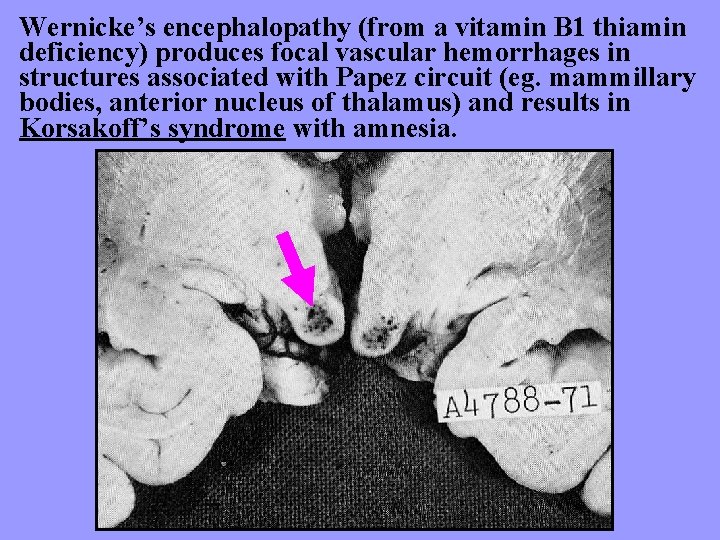 Wernicke’s encephalopathy (from a vitamin B 1 thiamin deficiency) produces focal vascular hemorrhages in