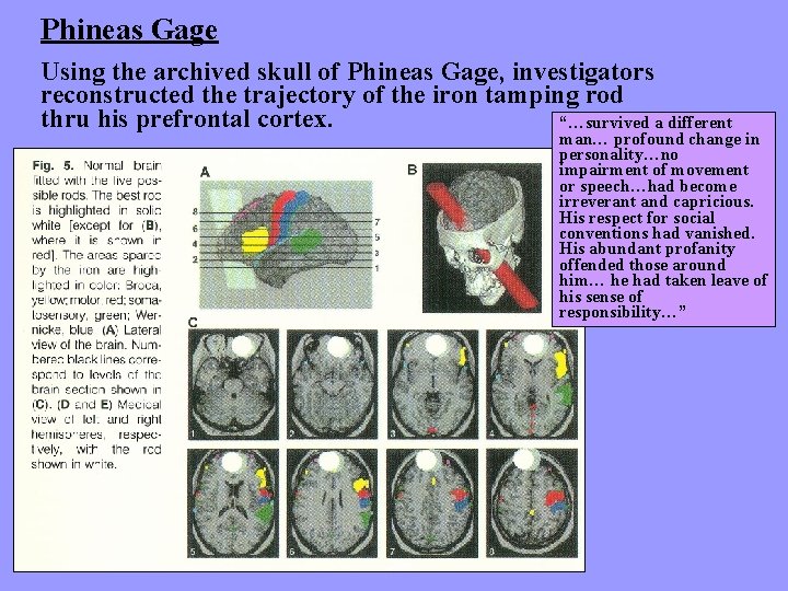 Phineas Gage Using the archived skull of Phineas Gage, investigators reconstructed the trajectory of