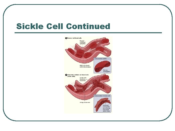 Sickle Cell Continued 
