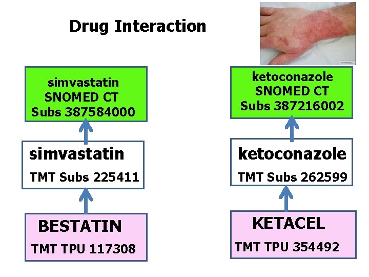 Drug Interaction simvastatin SNOMED CT Subs 387584000 ketoconazole SNOMED CT Subs 387216002 simvastatin ketoconazole