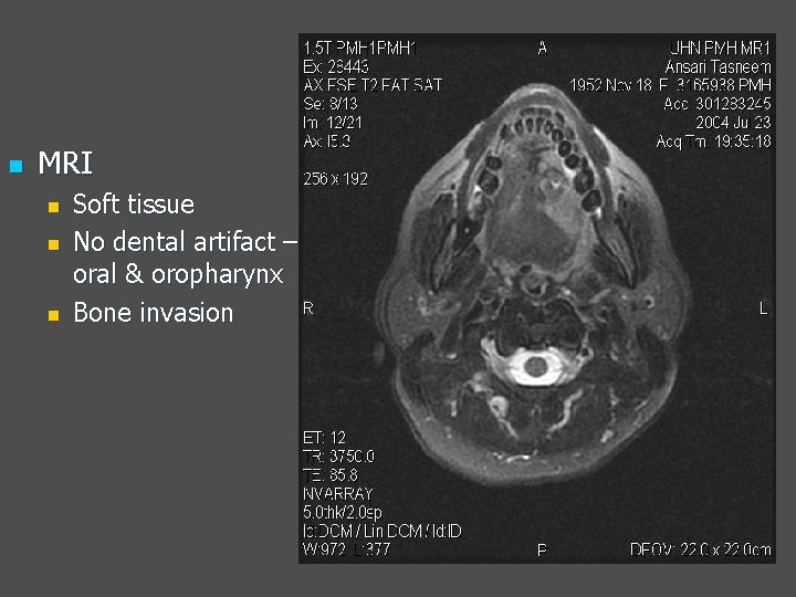 n MRI n n n Soft tissue No dental artifact – oral & oropharynx