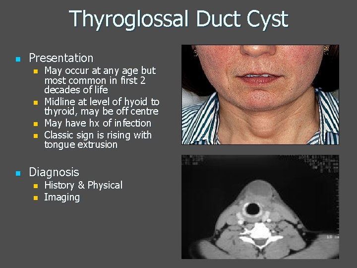Thyroglossal Duct Cyst n Presentation n n May occur at any age but most